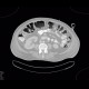 Layering of gas in the large bowel: CT - Computed tomography