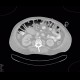 Layering of gas in the large bowel: CT - Computed tomography