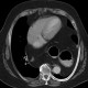 Hiatal hernia, upside-down stomach: CT - Computed tomography