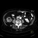 Carcinoma of ascending colon, colorectal carcinoma: CT - Computed tomography