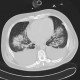 Bronchopneumonia, bilateral, pleural effusion: CT - Computed tomography