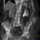 Staghorn calculus, casting stone, nephrolithiasis, VRT: CT - Computed tomography