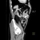 Renal tumour, oncocytoma: CT - Computed tomography