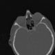 Onodi cell: CT - Computed tomography