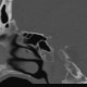 Onodi cell: CT - Computed tomography