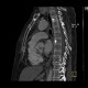 Osteoplastic skeletal metastases, breast carcinoma: CT - Computed tomography
