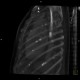 Osteoplastic skeletal metastases, breast carcinoma: CT - Computed tomography
