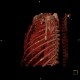 Osteoplastic skeletal metastases, breast carcinoma: CT - Computed tomography