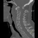 Osteolytic metastasis of cervical spine, fracture of dens axis, C2: CT - Computed tomography