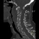 Osteolytic metastasis of cervical spine, fracture of dens axis, C2: CT - Computed tomography