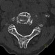 Osteolytic metastasis of cervical spine, fracture of dens axis, C2: CT - Computed tomography