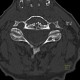 Osteolytic metastasis of cervical spine, fracture of dens axis, C2: CT - Computed tomography