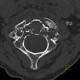 Osteolytic metastasis of cervical spine, fracture of dens axis, C2: CT - Computed tomography