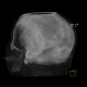 Osteoplastic metastases, prostate cancer: CT - Computed tomography