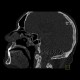 Osteoplastic metastases, prostate cancer: CT - Computed tomography