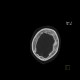 Osteoplastic metastases, prostate cancer: CT - Computed tomography