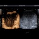 Liver hemangioma, huge, CEUS: US - Ultrasound