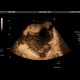 Liver hemangioma, huge, CEUS: US - Ultrasound