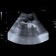 Renal stones, nephrolithiasis, casting stones, staghorn calculus: US - Ultrasound