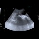 Renal stones, nephrolithiasis, casting stones, staghorn calculus: US - Ultrasound