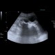 Renal stones, nephrolithiasis, casting stones, staghorn calculus: US - Ultrasound