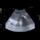 Renal stones, nephrolithiasis, casting stones, staghorn calculus: US - Ultrasound
