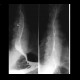 Traction diverticulum of oesophagus: RF - Fluoroscopy