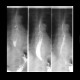 Traction diverticulum of oesophagus: RF - Fluoroscopy