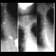 Traction diverticulum of oesophagus: RF - Fluoroscopy