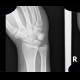 Os epipyramis, accessory bone: X-ray - Plain radiograph
