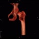 Osteolytic changes of femur: CT - Computed tomography