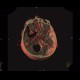 Osteolytic changes of facial skeleton: CT - Computed tomography