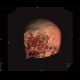 Osteolytic changes of facial skeleton: CT - Computed tomography