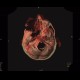 Osteolytic changes of facial skeleton: CT - Computed tomography
