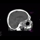 Osteolytic changes of facial skeleton: CT - Computed tomography