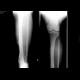 Chronic osteomyelitis and bone squestration: X-ray - Plain radiograph