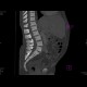 Osteomyelofibrosis: CT - Computed tomography