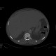 Osteomyelofibrosis: CT - Computed tomography