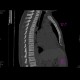 Osteomyelofibrosis: CT - Computed tomography