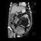 Ovarian carcinoma, carcinomatosis: CT - Computed tomography