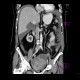 Ovarian carcinoma, carcinomatosis: CT - Computed tomography