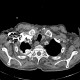 Pachypleuritis after talc pleurodesis: CT - Computed tomography