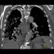 Pachypleuritis after talc pleurodesis: CT - Computed tomography