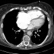 Pulmonary hypertension: CT - Computed tomography