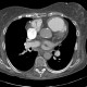 Pulmonary hypertension: CT - Computed tomography