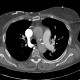 Pulmonary hypertension: CT - Computed tomography