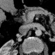 Pancreas divisum on CT, mininum intensity projection, MinIP: CT - Computed tomography