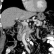 Pancreas divisum on CT, mininum intensity projection, MinIP: CT - Computed tomography