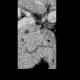 Pancreas divisum on CT, mininum intensity projection, MinIP: CT - Computed tomography