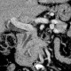Pancreas divisum on CT, mininum intensity projection, MinIP: CT - Computed tomography